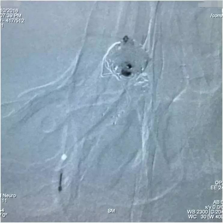 基底动脉顶端动脉瘤加左侧小脑上动脉瘤以Y型支架结合弹簧圈栓塞