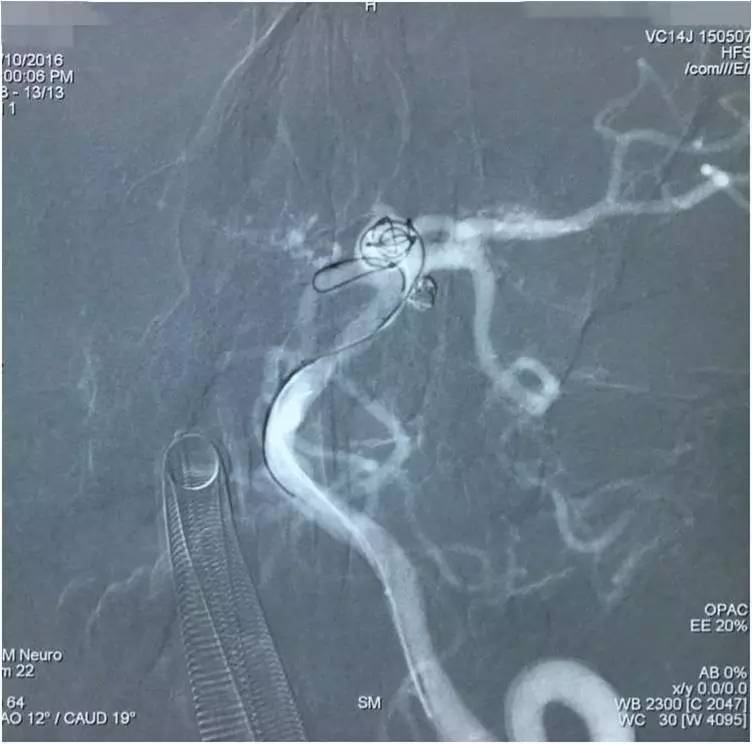 基底动脉顶端动脉瘤加左侧小脑上动脉瘤以Y型支架结合弹簧圈栓塞