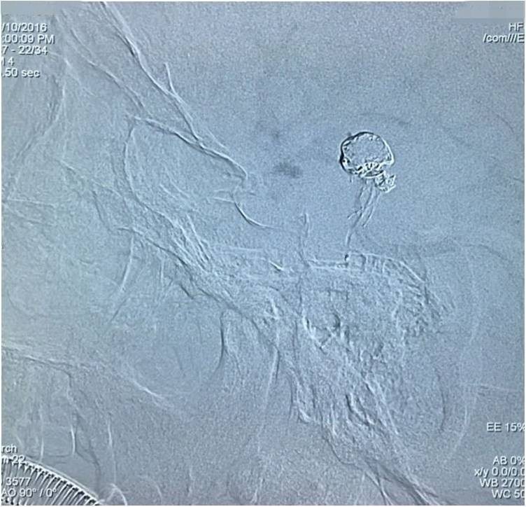 基底动脉顶端动脉瘤加左侧小脑上动脉瘤以Y型支架结合弹簧圈栓塞
