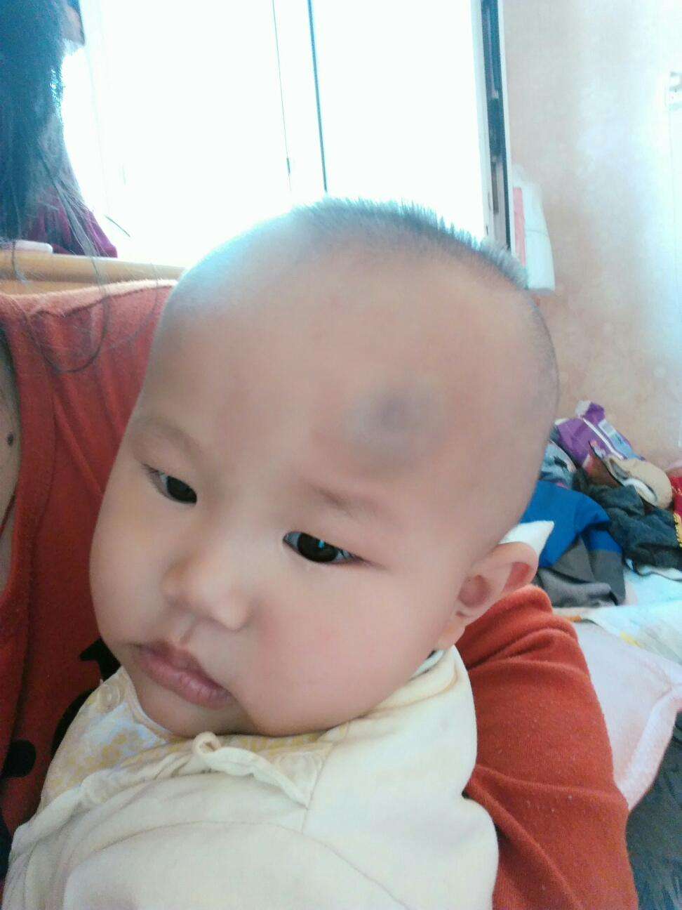 宝宝脑袋摔了包用什么药,宝宝脑袋摔了个大包