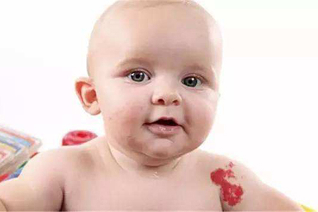 新生儿胎记种类与图片,新生儿胎记种类都有哪些