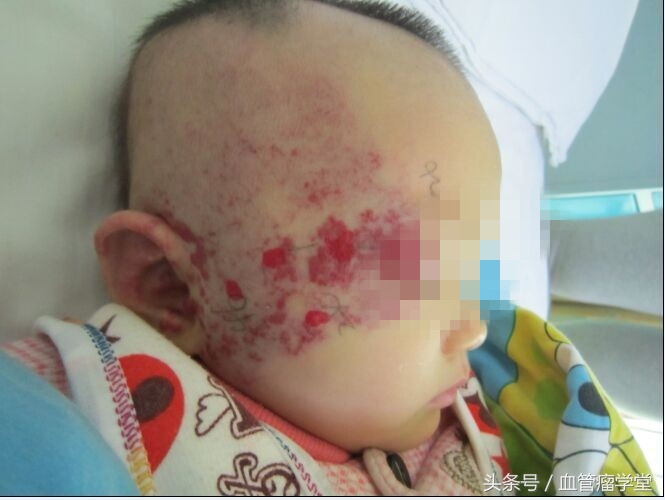 尿素可以治疗湿疹吗,血管瘤打尿素针多少钱一针