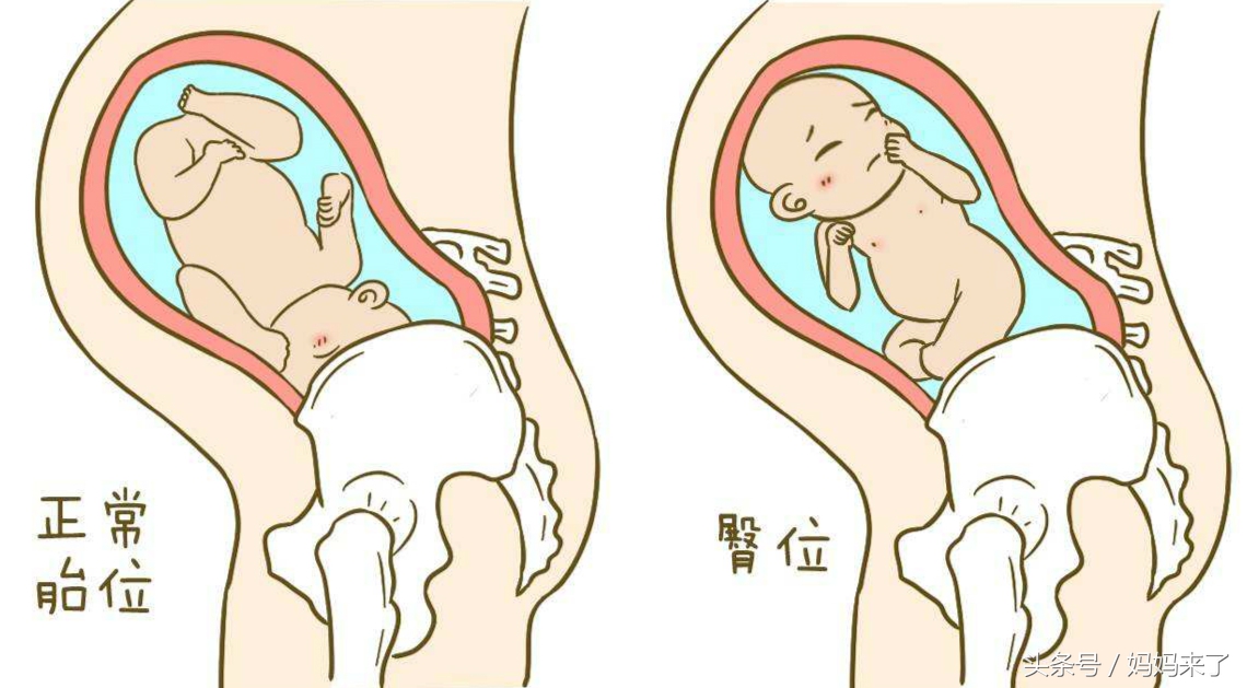 胎位不正也不用剖宫产?这招帮你宝宝“转正”!准妈妈别担心!