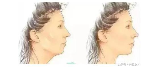 线雕小切口面雕拉皮的区别,线雕与拉皮术