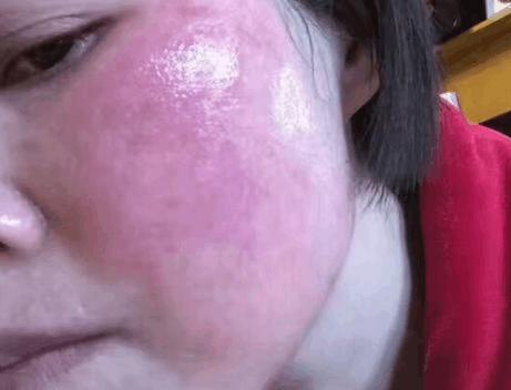 激素脸怎么治疗可以好得快,激素脸怎么治疗才能好得快