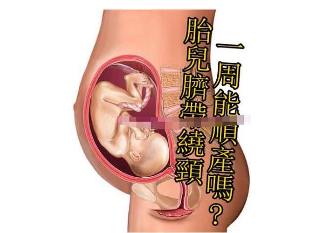 如果胎儿绕脐带了孕妈会有反应吗,孕中期脐带绕颈一周怎么快速矫正