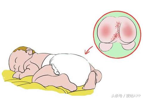 尿布疹需要处理吗,尿布疹