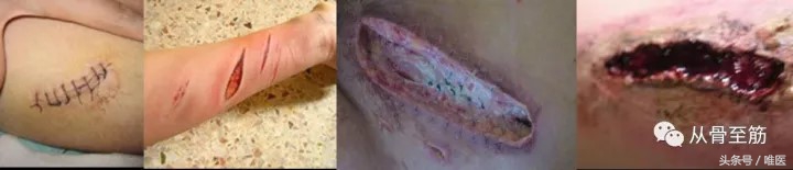 伤口换药越勤越好吗,伤口换药还是好疼