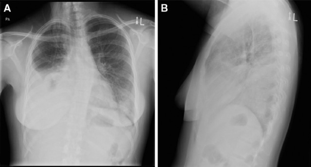 病例讨论:宫颈癌患者为何出现呼吸急促和胸痛?