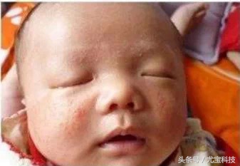 宝宝脸上有奶癣湿疹怎么好得快,宝宝脸上长奶癣用什么药膏好得快