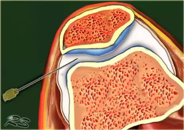 超声引导穿刺和介入穿刺的优缺点,关节超声引导