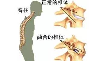 张嘉译的病是强直性脊柱炎吗,张嘉译强直性脊柱炎2019年视频