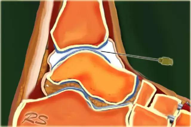 超声引导下穿刺手法解析,超声介入穿刺和普通穿刺的区别