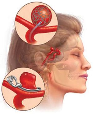 颅内动脉瘤破裂后死亡率,动脉瘤和脑肿瘤哪个严重