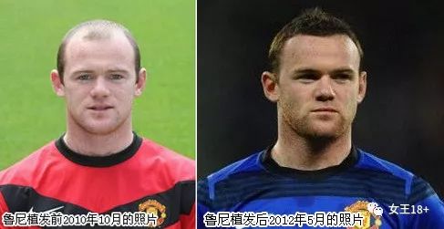 发际线后移男怎么拯救,18岁发际线后移怎么补救男