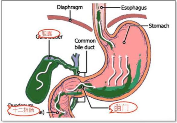 胃病食管反流怎么治好,反流性胃炎中医的解释