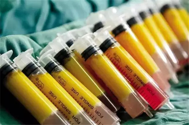 自体脂肪填充泪沟多久恢复自然,自体脂肪填充泪沟多久恢复正常