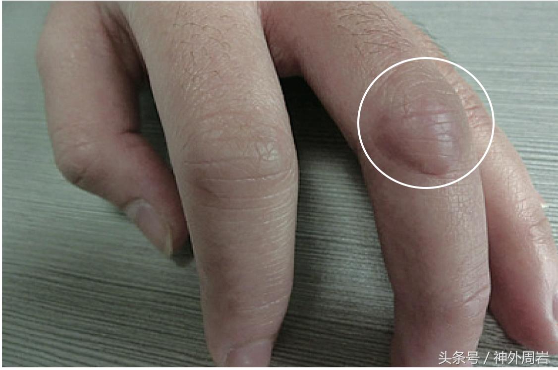 神经断裂后的再生痛苦,创伤性神经瘤症状和治疗