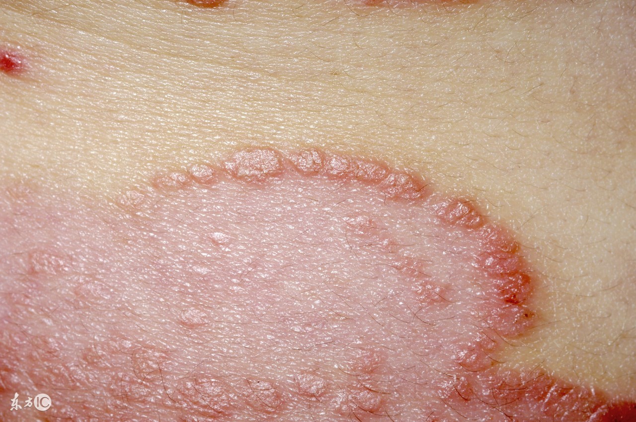 药物引起银屑病能治愈吗,治疗银屑病内服的药有哪些