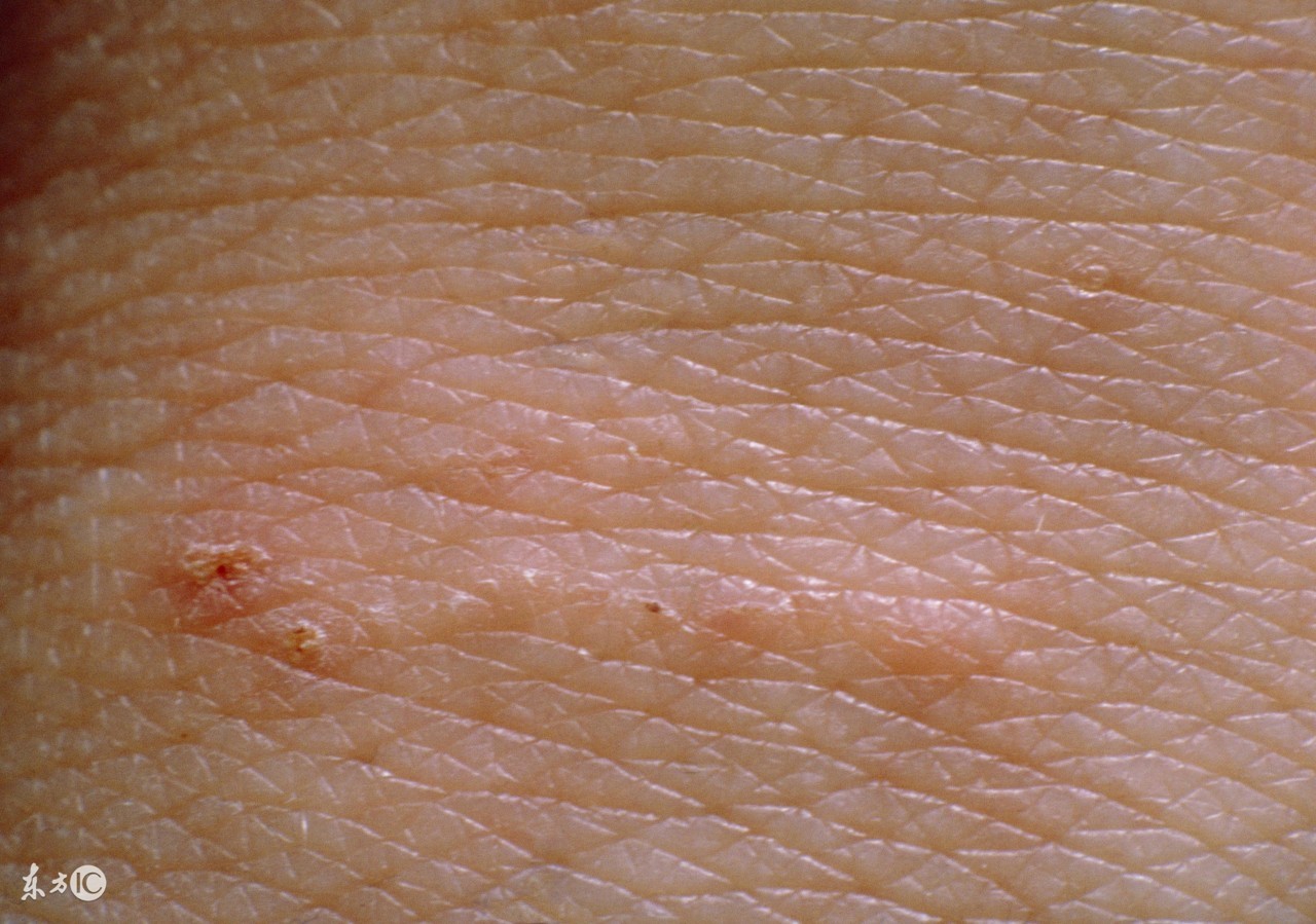 预防疥疮应采取以下措施,治疗疥疮最有效的方法