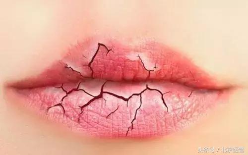 嘴唇干裂怎么快速恢复润唇膏,嘴唇干裂怎么润唇