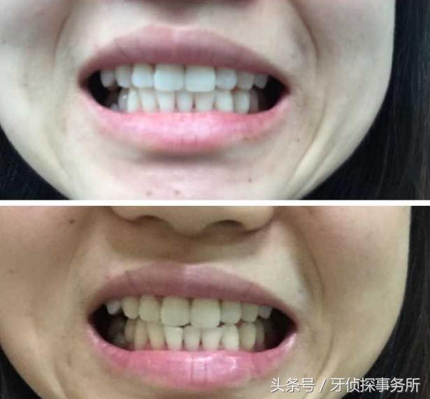 牙齿美白和冷光美白有啥区别,牙齿黄了很多年冷光美白仪有用吗