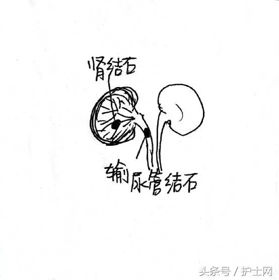 经常跳跳就可以将肾结石蹦出来吗,经常跳跳有助于长高吗