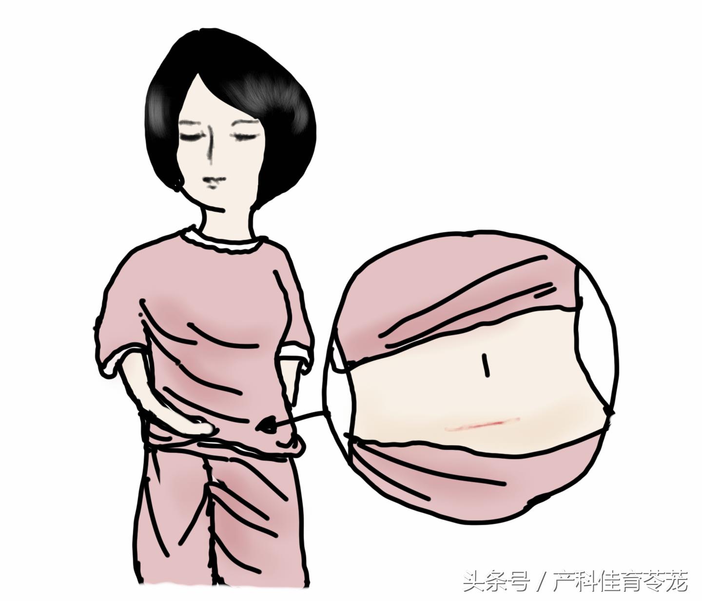 剖宫产那么大个口子，护理并不难