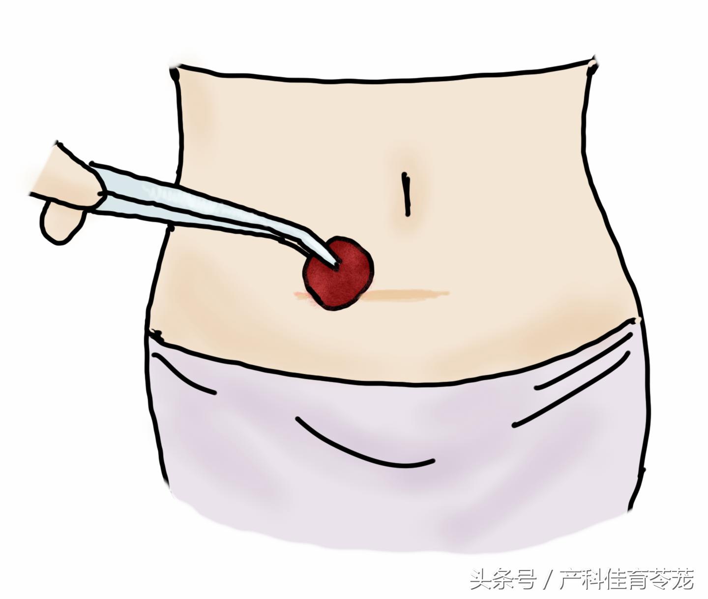 剖宫产那么大个口子，护理并不难