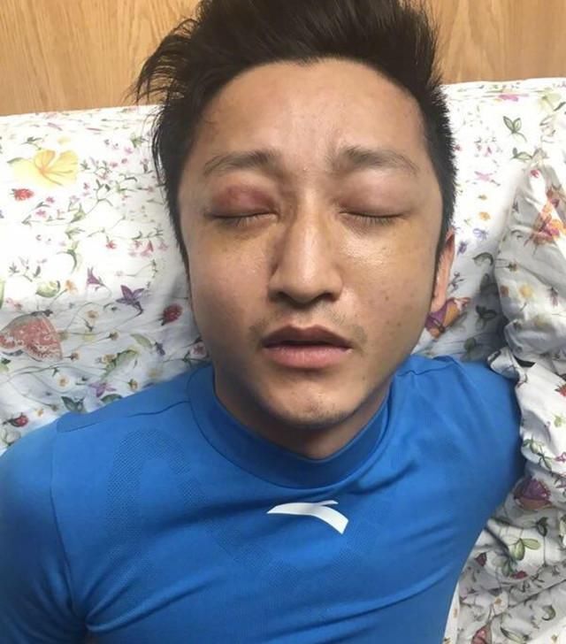 邹市明透露自己退役根本原因：眼睛被打坏，看东西不在一个水平线