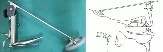 声音嘶哑喉镜没有问题怎么治疗,声音嘶哑为什么医生让做喉镜