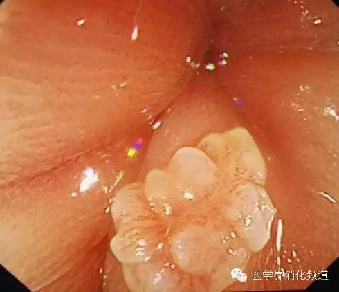 食管良性肿瘤科普视频,食管乳头状瘤和增生区别