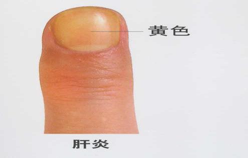 小小指甲,小小的指甲隐藏大大的健康秘密