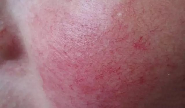 酒渣鼻严重怎么彻底治疗,酒渣鼻难道真的看不好吗