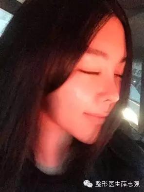 科普｜隆鼻假体，你知道不知道的那些事儿——扒一扒硅胶和膨体