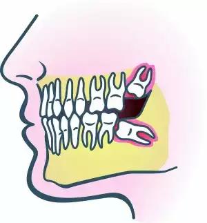 智齿发炎轻症和重症,智齿轻度龋坏怎么做