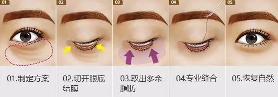 眼袋显老还是泪沟显老,40岁眼袋有泪沟怎么办