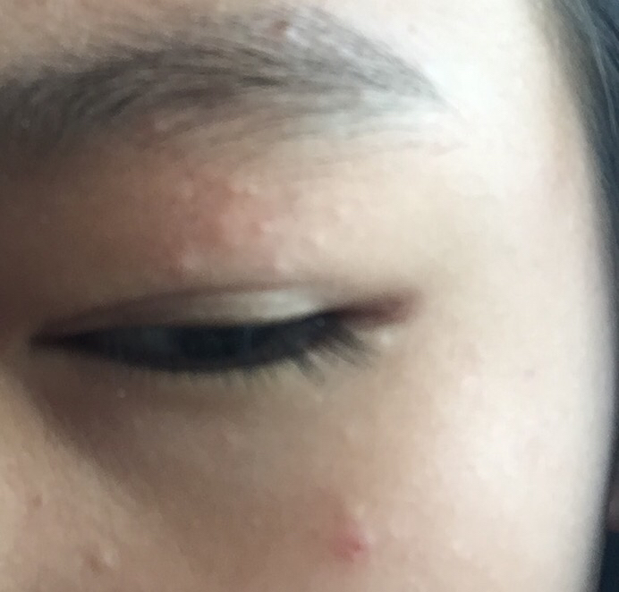 脸部两侧长痘是什么原因怎么办,脸部不同部位长痘是什么原因