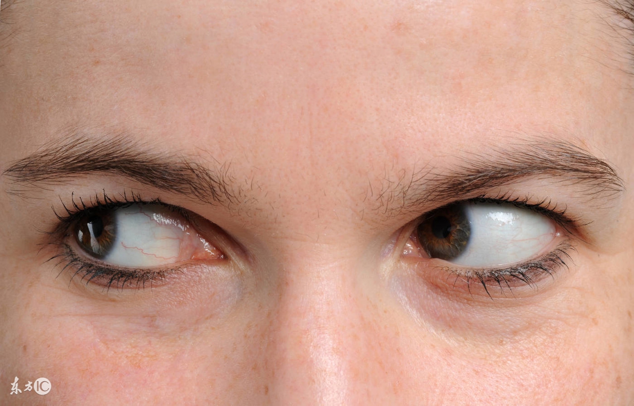 两眼近视度数有差距,该怎么办?