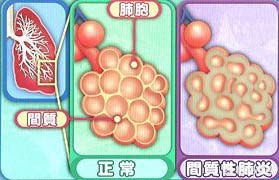 间质性肺病用什么药治疗,间质性肺病能经常吃消炎药吗