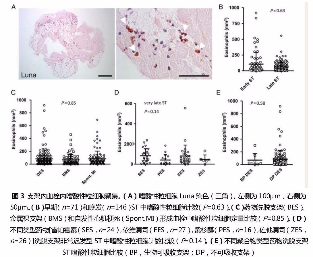 支架内血栓怎么处理,支架内血栓的原因及表现