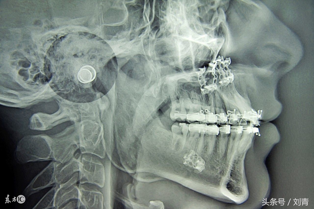 牙齿地包天怎么矫正最佳时间,地包天7岁换牙期间可以矫正吗