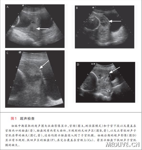 胎盘不正,孕妇因宗教信仰拒绝输血,如何解决?