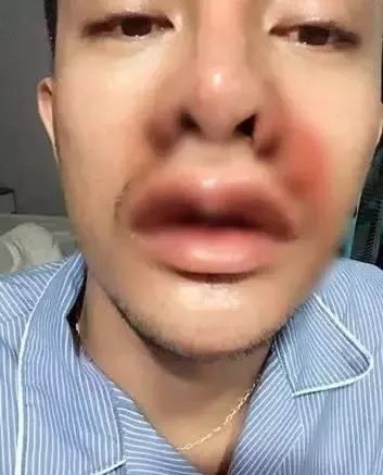 丑男整容变帅哥对比照,长得太丑了找不到老婆