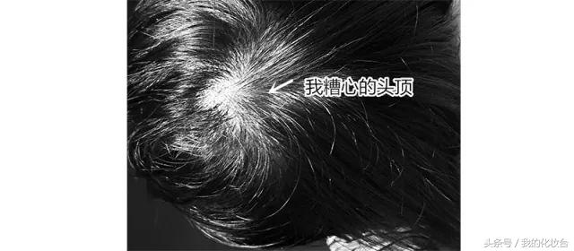 脱发严重怎么让头发蓬松,头发容易贴头皮教你一招