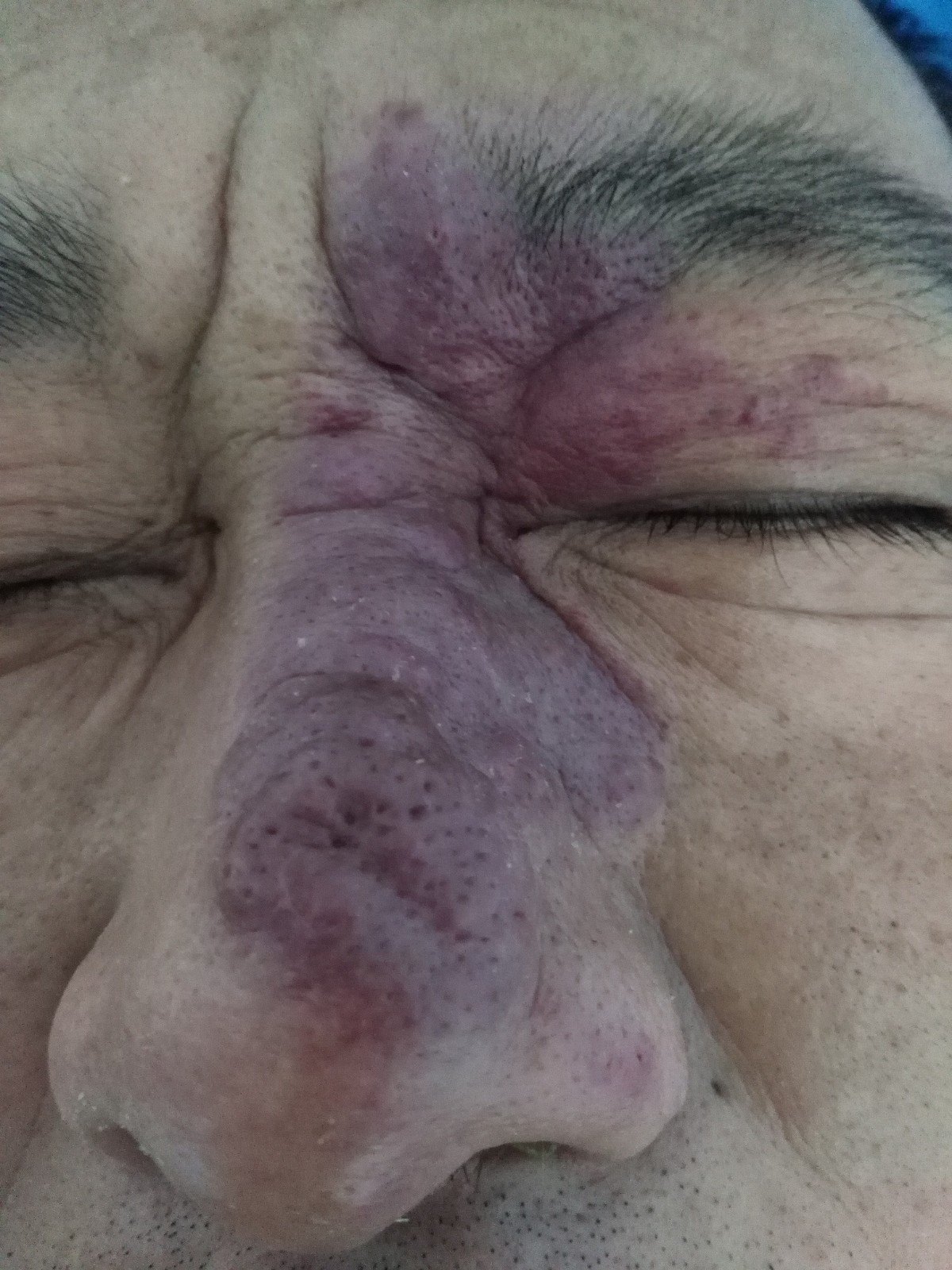 红胎记好治疗吗,红胎记好治吗