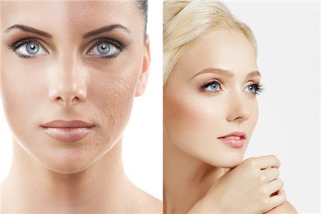 脸部毛孔粗大解决方法,脸部汗毛孔粗大怎么解决