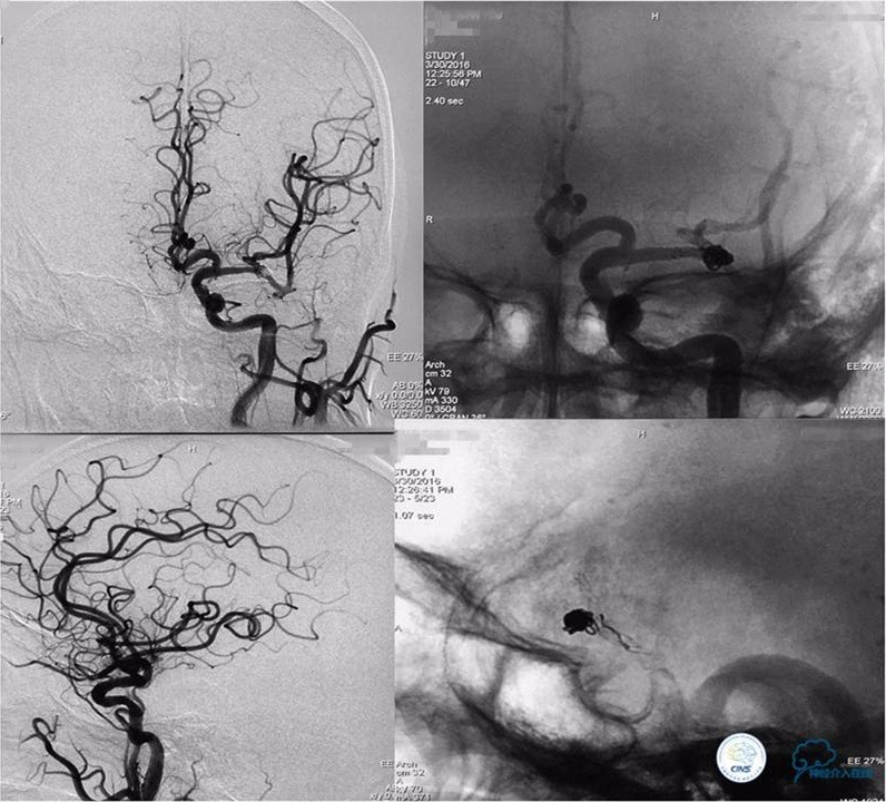 脑动脉瘤并颈动脉狭窄怎么治疗,脑动脉血管狭窄介入治疗效果好吗