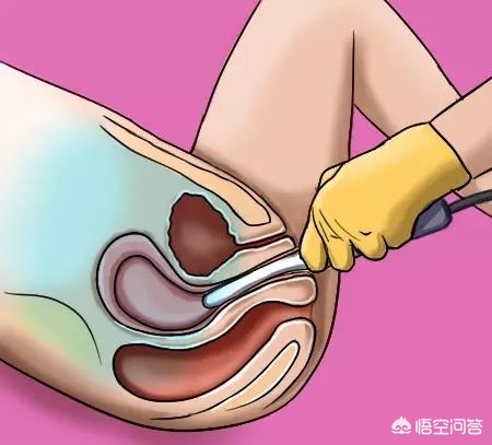 b超可以代替内检吗,b超能代替nt吗