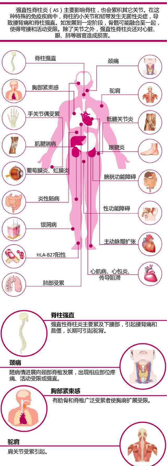 强直性脊柱炎的临床诊断,强直性脊柱炎诊断标准与治疗